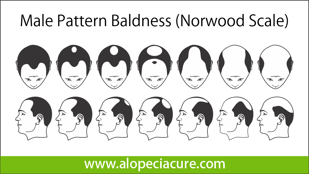 male hair loss